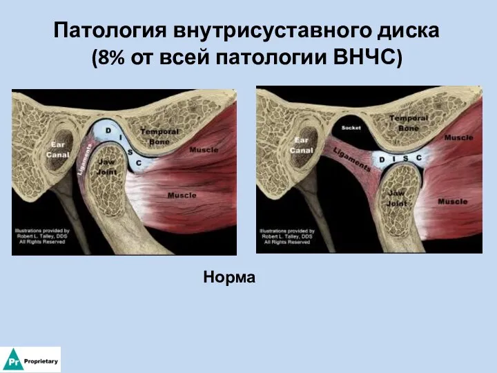 Патология внутрисуставного диска (8% от всей патологии ВНЧС) Норма