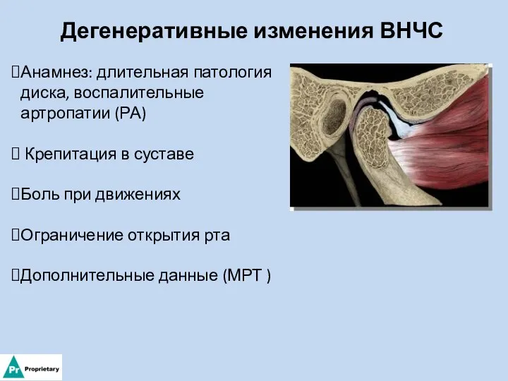 Дегенеративные изменения ВНЧС Анамнез: длительная патология диска, воспалительные артропатии (РА) Крепитация