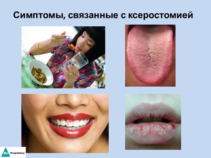 Симптомы, связанные с ксеростомией