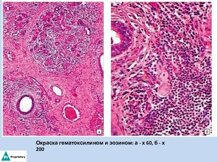 Окраска гематоксилином и эозином: а - х 60, б - х 200