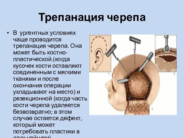 Трепанация черепа В ургентных условиях чаще проводится трепанация черепа. Она может