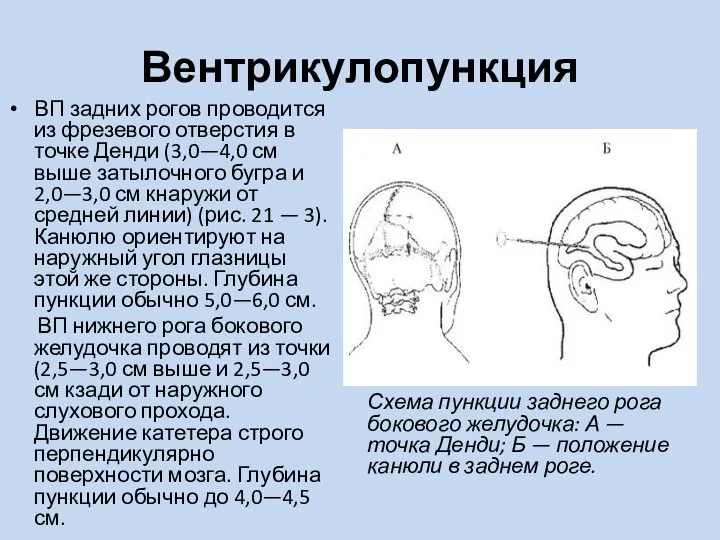 Вентрикулопункция ВП задних рогов проводится из фрезевого отверстия в точке Денди