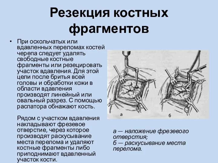 Резекция костных фрагментов При оскольчатых или вдавленных переломах костей черепа следует