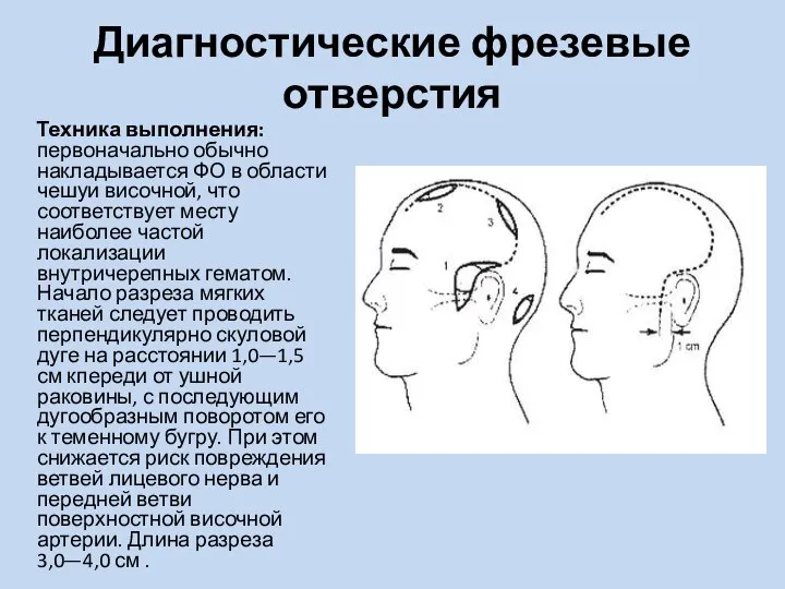 Диагностические фрезевые отверстия Техника выполнения: первоначально обычно накладывается ФО в области