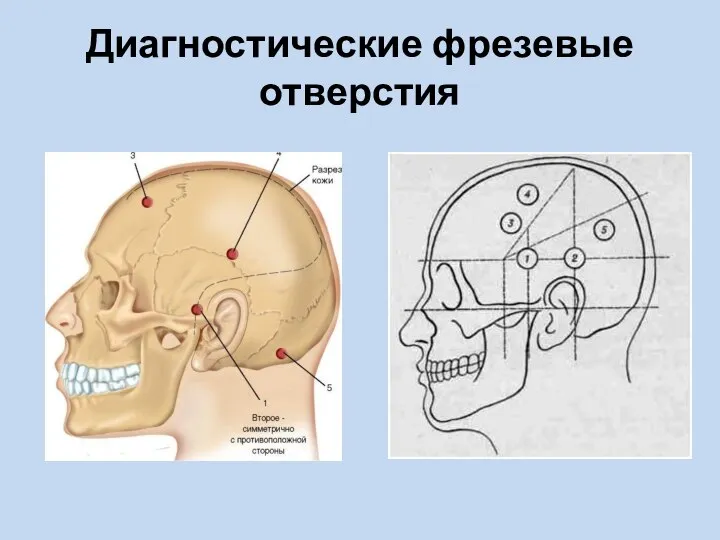 Диагностические фрезевые отверстия