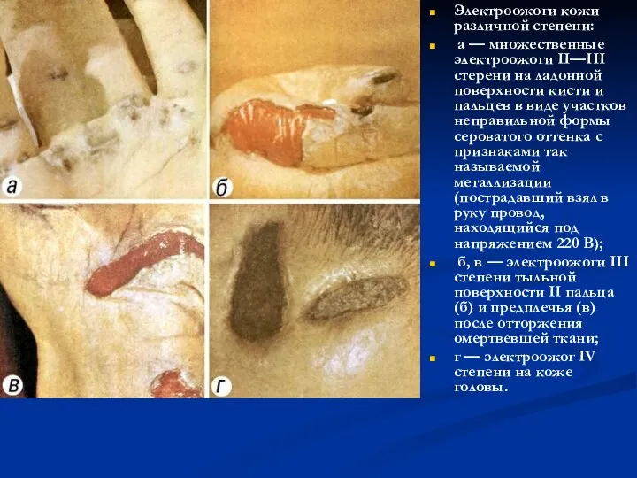 Электроожоги кожи различной степени: а — множественные электроожоги II—III стерени на