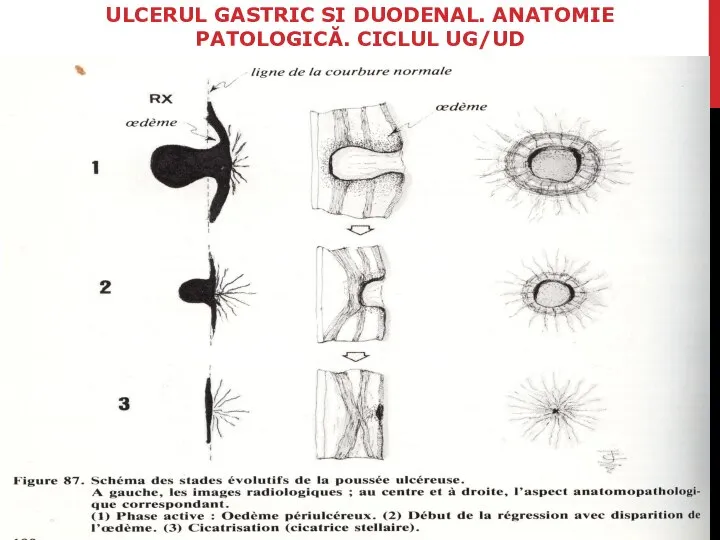 ULCERUL GASTRIC SI DUODENAL. ANATOMIE PATOLOGICĂ. CICLUL UG/UD