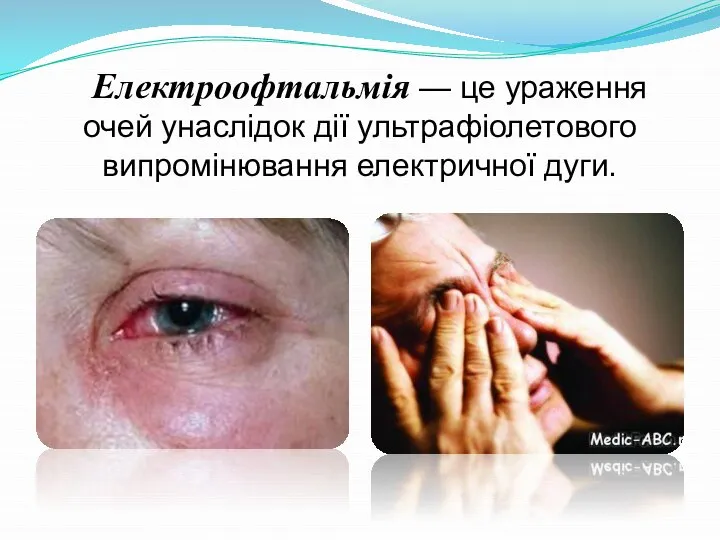Електроофтальмія — це ураження очей унаслідок дії ультрафіолетового випромінювання електричної дуги.