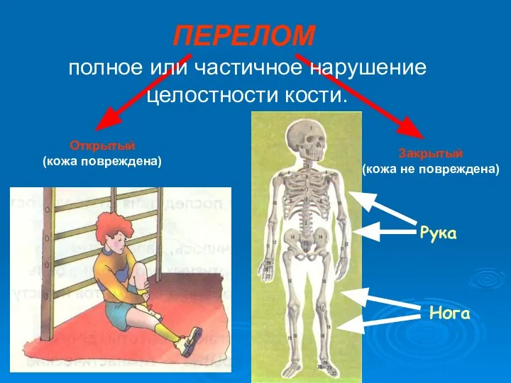 полное или частичное нарушение целостности кости. Рука ПЕРЕЛОМ Нога Открытый (кожа повреждена) Закрытый (кожа не повреждена)