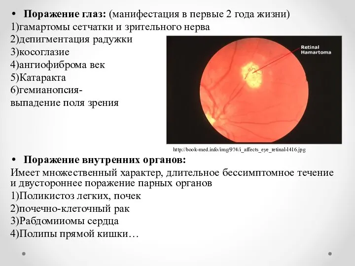 Поражение глаз: (манифестация в первые 2 года жизни) 1)гамартомы сетчатки и