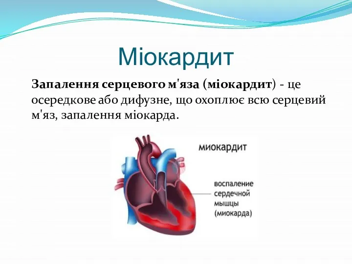 Міокардит Запалення серцевого м'яза (міокардит) - це осередкове або дифузне, що