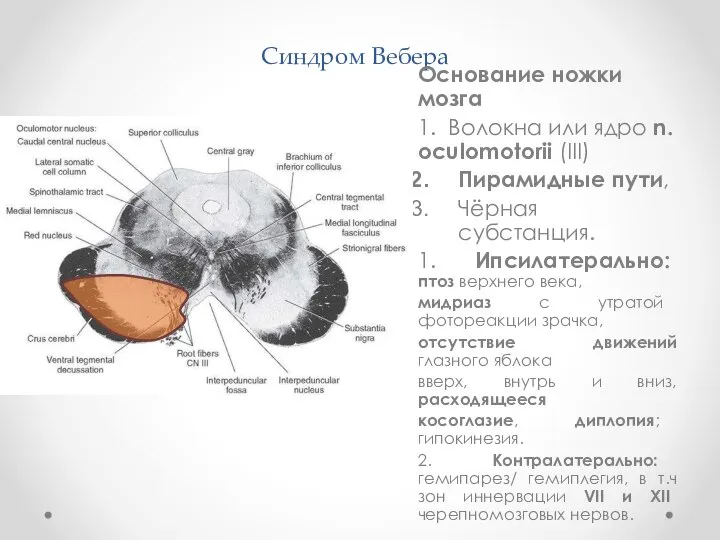 Синдром Вебера Основание ножки мозга 1. Волокна или ядро n. oculomotorii