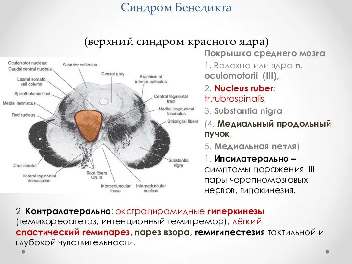 Синдром Бенедикта (верхний синдром красного ядра) Покрышка среднего мозга 1. Волокна