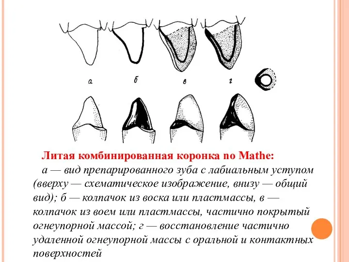 Литая комбинированная коронка no Mathе: а — вид препарированного зуба с