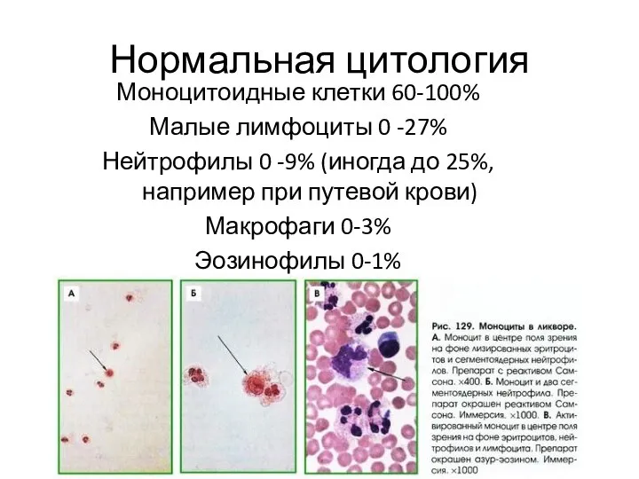Нормальная цитология Моноцитоидные клетки 60-100% Малые лимфоциты 0 -27% Нейтрофилы 0