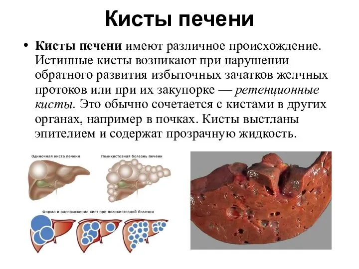 Кисты печени Кисты печени имеют различное происхождение. Истинные кисты возникают при