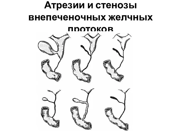 Атрезии и стенозы внепеченочных желчных протоков