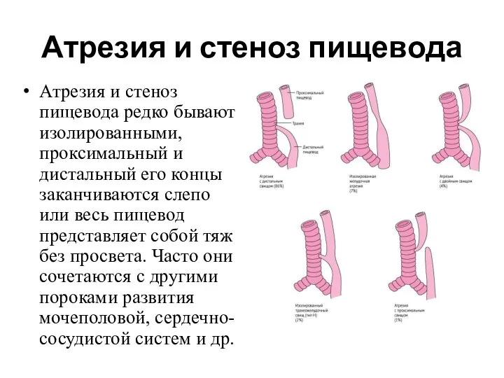 Атрезия и стеноз пищевода Атрезия и стеноз пищевода редко бывают изолированными,