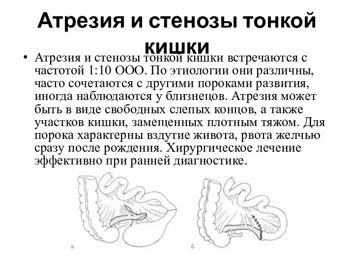 Атрезия и стенозы тонкой кишки Атрезия и стенозы тонкой кишки встречаются