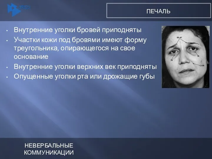 Внутренние уголки бровей приподняты Участки кожи под бровями имеют форму треугольника,