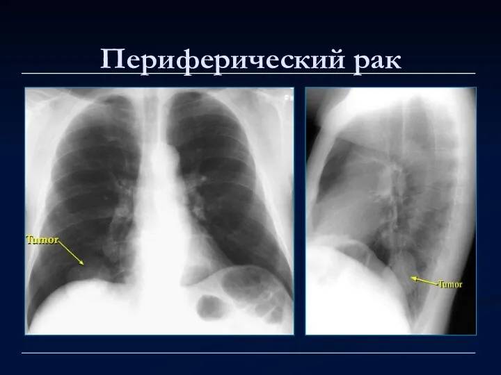 Периферический рак