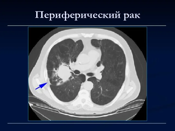 Периферический рак