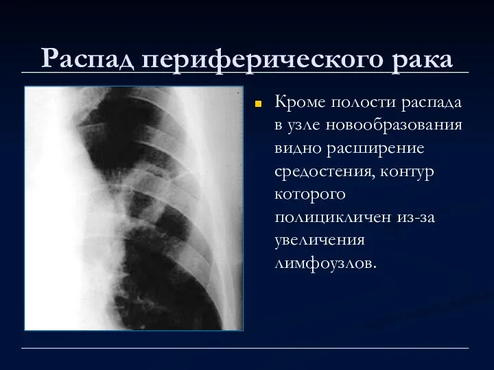 Распад периферического рака Кроме полости распада в узле новообразования видно расширение