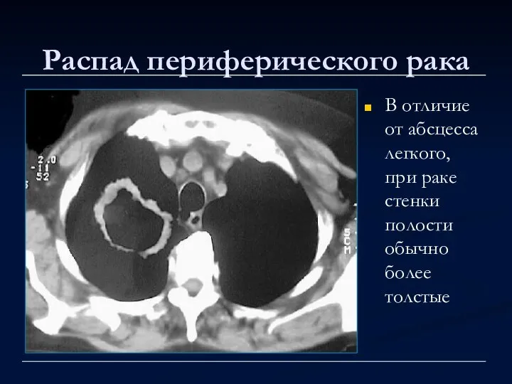 Распад периферического рака В отличие от абсцесса легкого, при раке стенки полости обычно более толстые