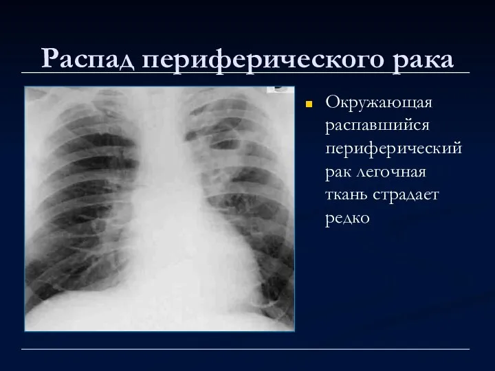 Распад периферического рака Окружающая распавшийся периферический рак легочная ткань страдает редко