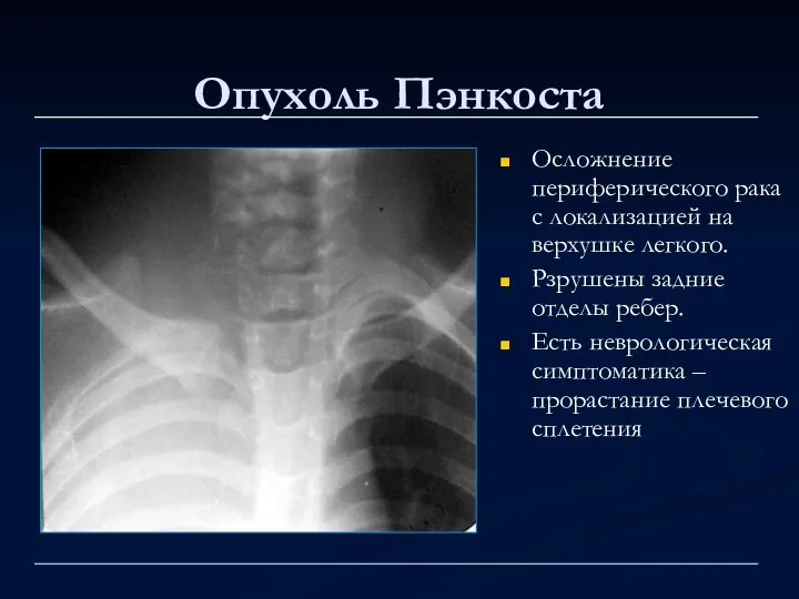 Опухоль Пэнкоста Осложнение периферического рака с локализацией на верхушке легкого. Рзрушены