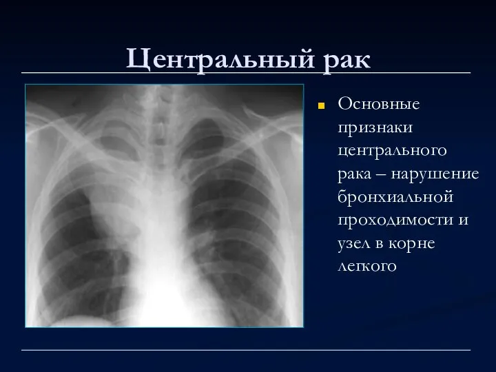 Центральный рак Основные признаки центрального рака – нарушение бронхиальной проходимости и узел в корне легкого