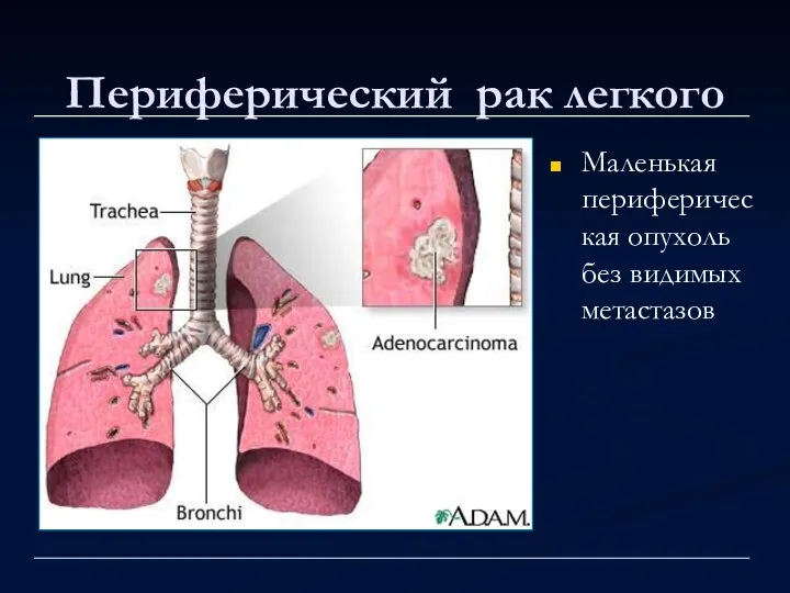 Периферический рак легкого Маленькая периферическая опухоль без видимых метастазов