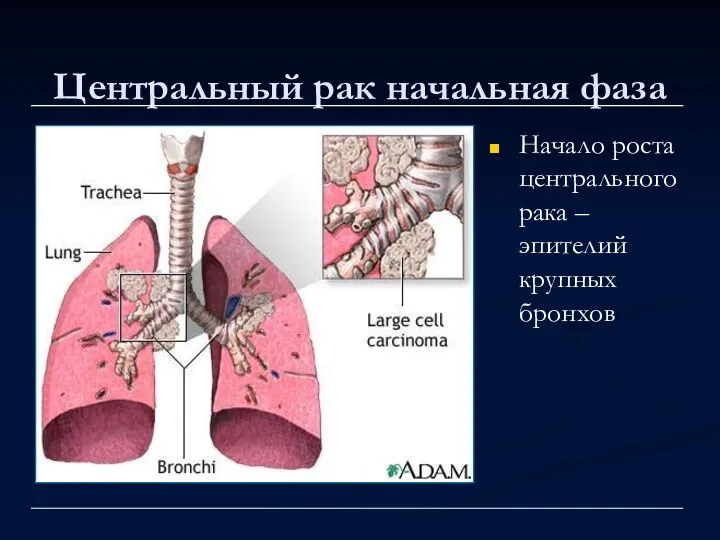 Центральный рак начальная фаза Начало роста центрального рака – эпителий крупных бронхов