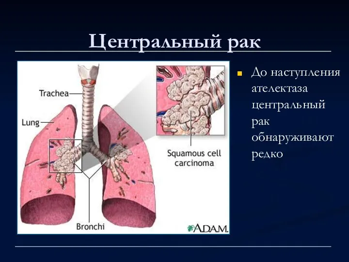 Центральный рак До наступления ателектаза центральный рак обнаруживают редко