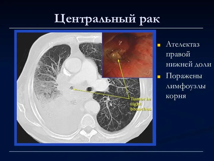 Центральный рак Ателектаз правой нижней доли Поражены лимфоузлы корня