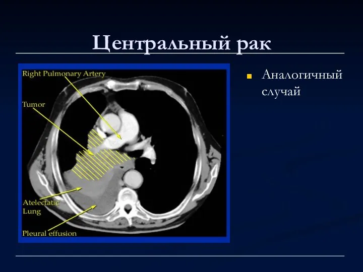 Центральный рак Аналогичный случай