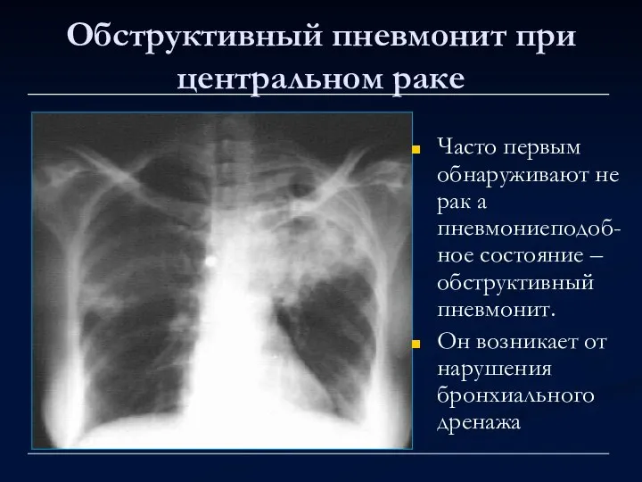 Обструктивный пневмонит при центральном раке Часто первым обнаруживают не рак а