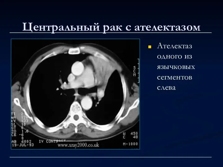 Центральный рак с ателектазом Ателектаз одного из язычковых сегментов слева