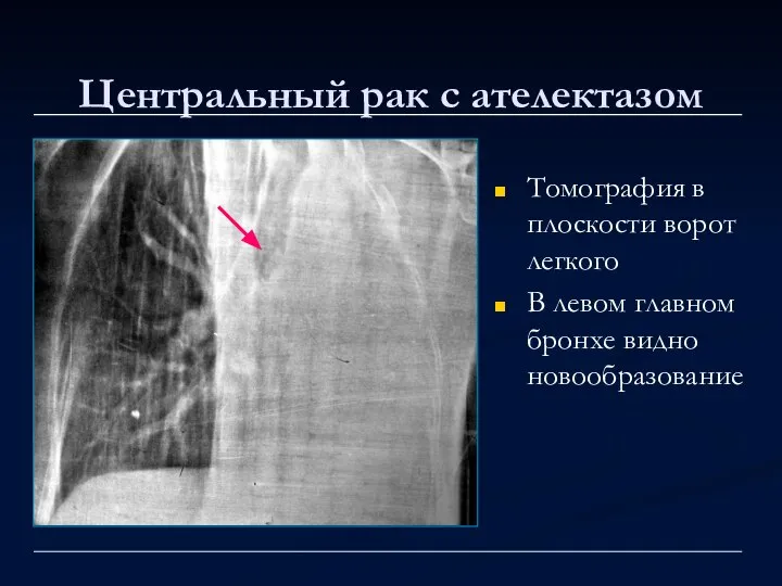 Центральный рак с ателектазом Томография в плоскости ворот легкого В левом главном бронхе видно новообразование