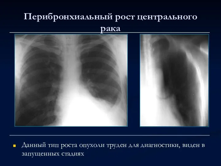 Перибронхиальный рост центрального рака Данный тип роста опухоли труден для диагностики, виден в запущенных стадиях