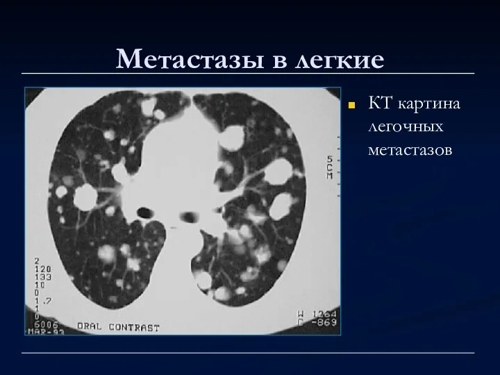 Метастазы в легкие КТ картина легочных метастазов