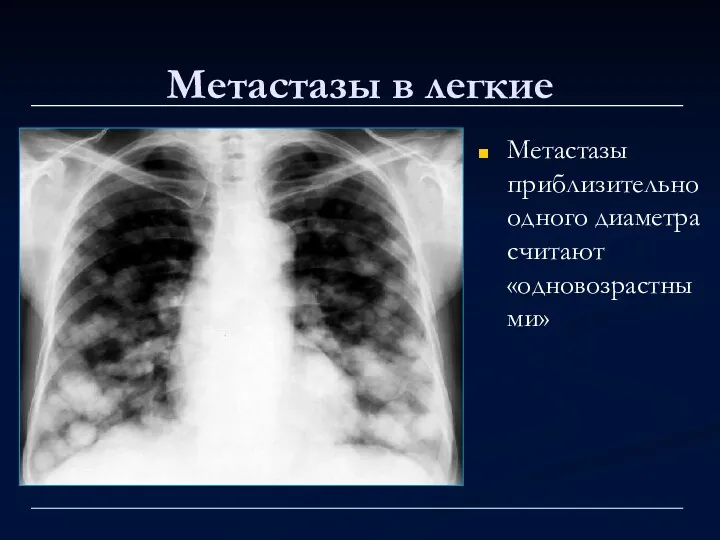 Метастазы в легкие Метастазы приблизительно одного диаметра считают «одновозрастными»