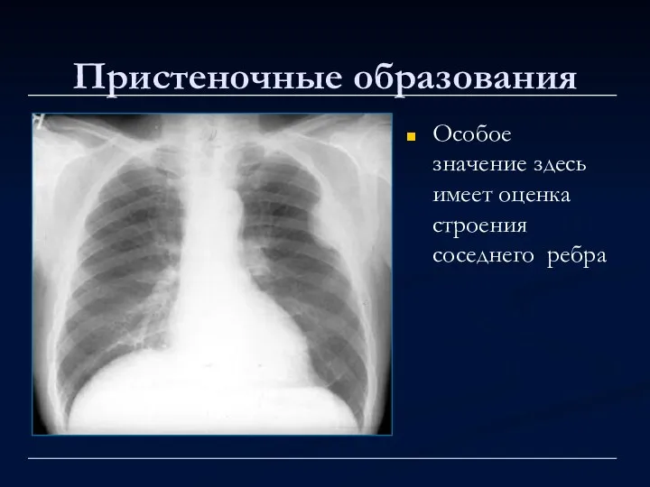 Пристеночные образования Особое значение здесь имеет оценка строения соседнего ребра