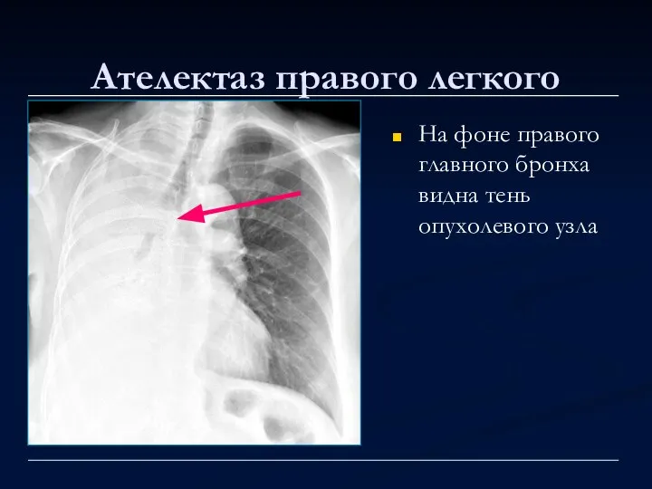 Ателектаз правого легкого На фоне правого главного бронха видна тень опухолевого узла