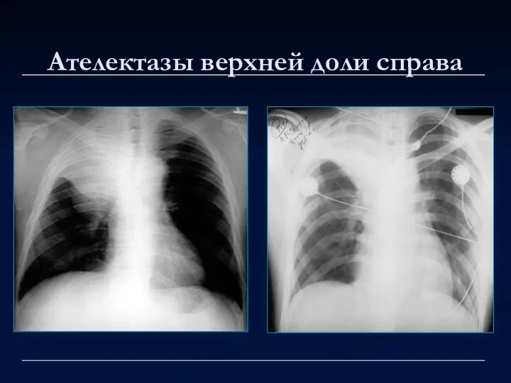 Ателектазы верхней доли справа