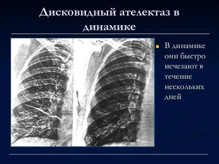 Дисковидный ателектаз в динамике В динамике они быстро исчезают в течение нескольких дней