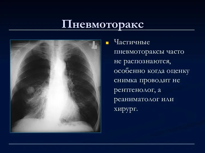 Пневмоторакс Частичные пневмотораксы часто не распознаются, особенно когда оценку снимка проводит