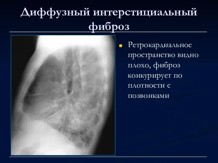 Диффузный интерстициальный фиброз Ретрокардиальное пространство видно плохо, фиброз конкурирует по плотности с позвонками