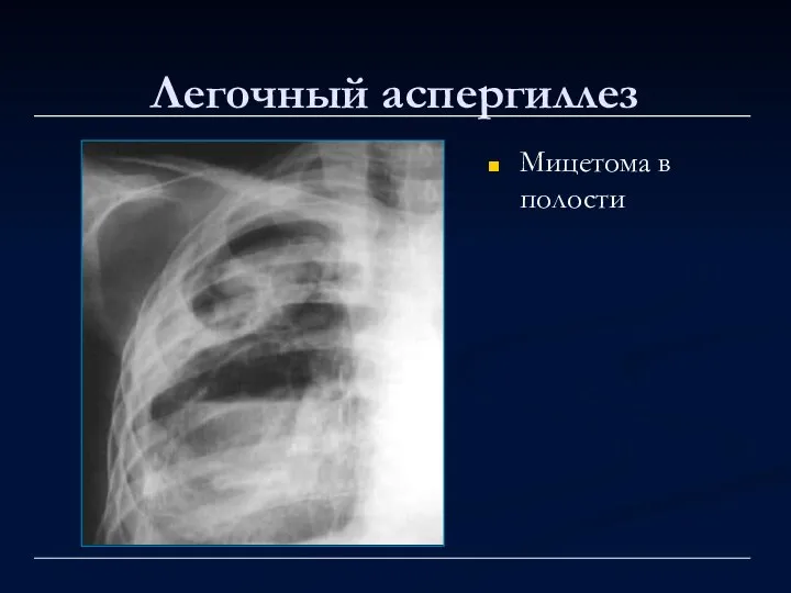 Легочный аспергиллез Мицетома в полости