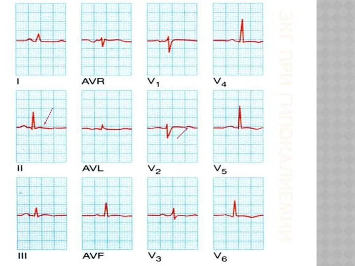 ЭКГ ПРИ ГИПОКАЛИЕМИИ